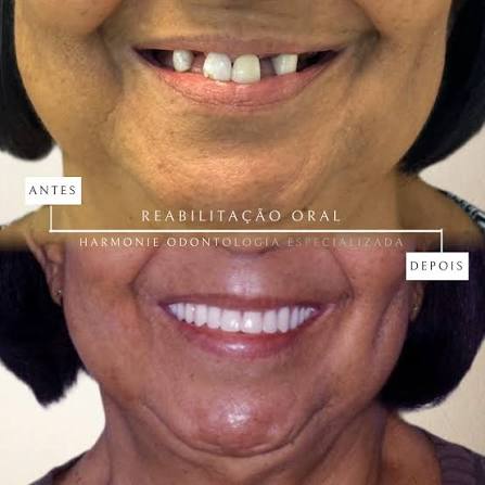 Implante dentário antes do procedimento
