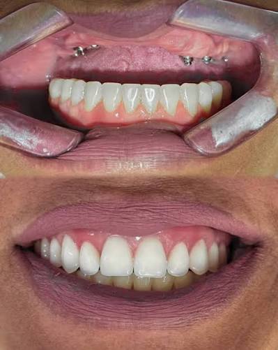 Implante dentário resultado final