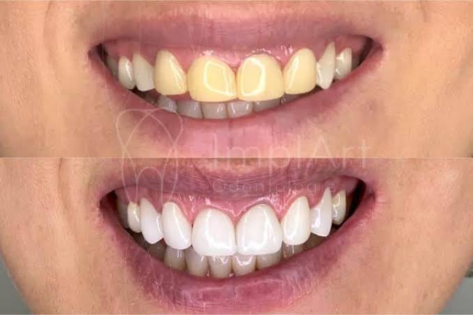 Resultado de tratamento com lentes de contato
