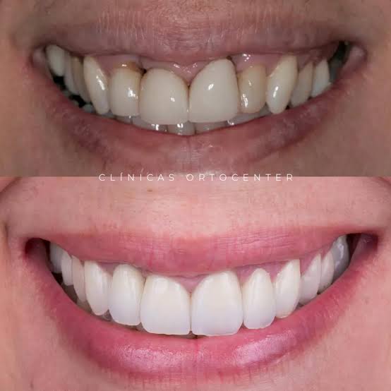 Sorriso restaurado com lentes de contato